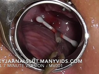 Amateur FreyjaAnalslut : Removing her IUD - good-looking well-found glory in Freyja's Cervix, fabrication her fecund usually - Full version on ManyVids